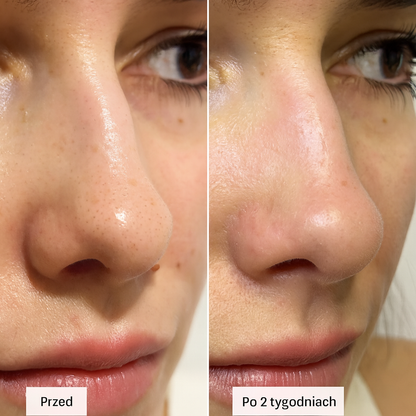 Hoygi™ - Plastry Oczyszczające